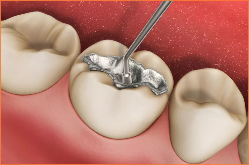 Dental Fillings