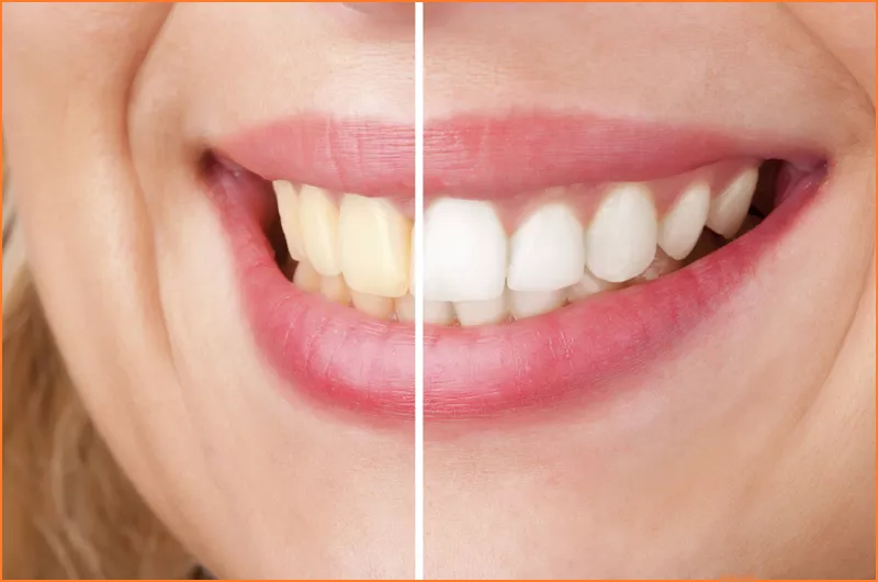 Tooth Whitening
