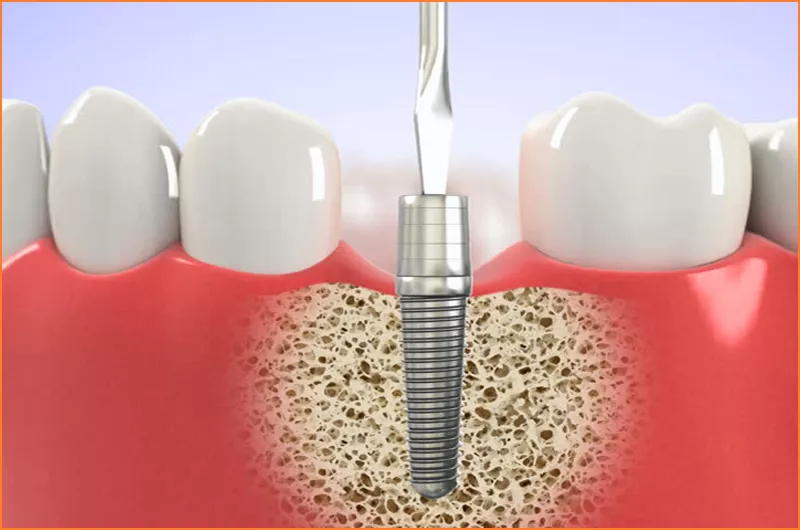 Dental implant