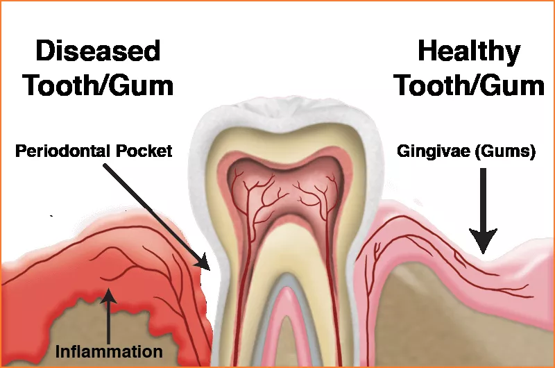 Gum Treatment