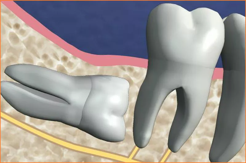 Extraction of Third Molars