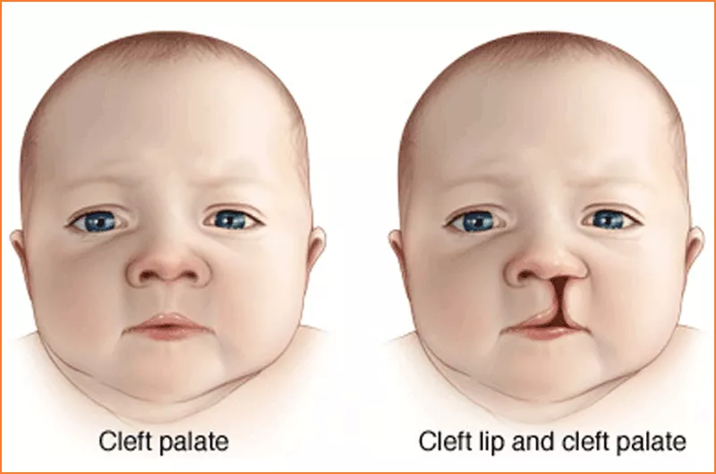 Cleft Lip & Palate